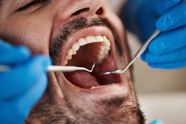 Best Wisdom Tooth Removal  in Paloma Creek South, TX